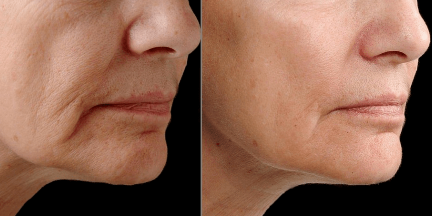 Fractional laser rejuvenation - effects