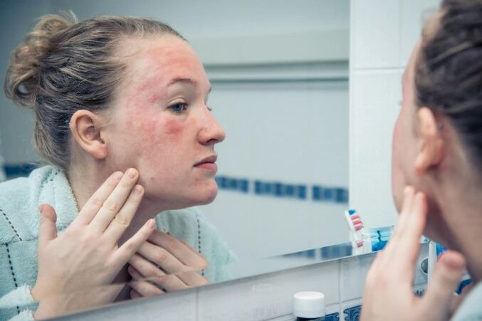 Chronic skin diseases in the deterioration stage
