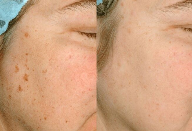 Removal of coloring on the skin